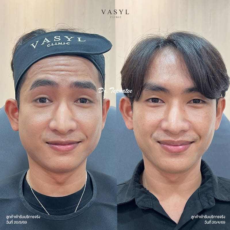 ภาพก่อนและหลังโปรแกรมฉีดโบทูลินัมท็อกซินดูแลริ้วรอยบริเวณหน้าผาก
