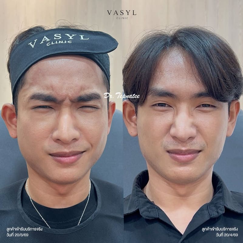 ภาพก่อนและหลังโปรแกรมฉีดโบทูลินัมท็อกซินดูแลริ้วรอยหว่างคิ้ว