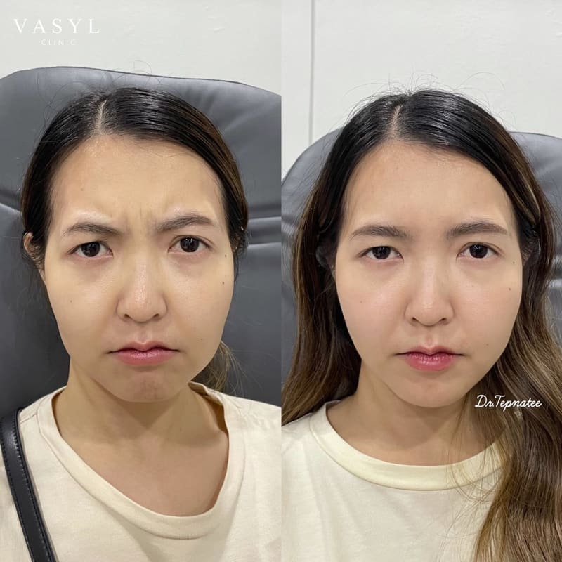 ภาพก่อนและหลังโปรแกรมฉีดโบทูลินัมท็อกซินดูแลริ้วรอยหว่างคิ้ว ผู้รับบริการหญิง