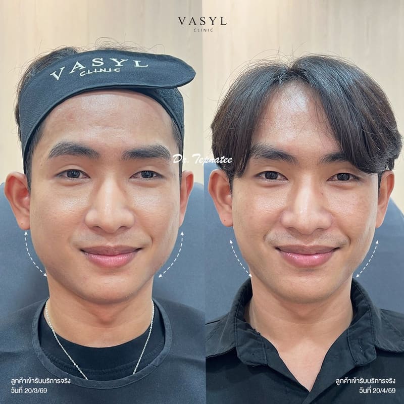 ภาพก่อนและหลังโปรแกรมฉีดโบทูลินัมท็อกซินบริเวณกล้ามเนื้อกราม
