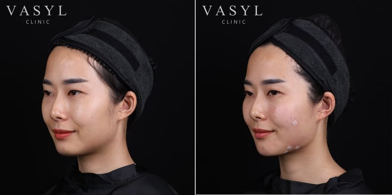 ภาพก่อนและหลังโปรแกรมฉีดกระตุ้นคอลลาเจน มุมเฉียงซ้าย 45 องศา