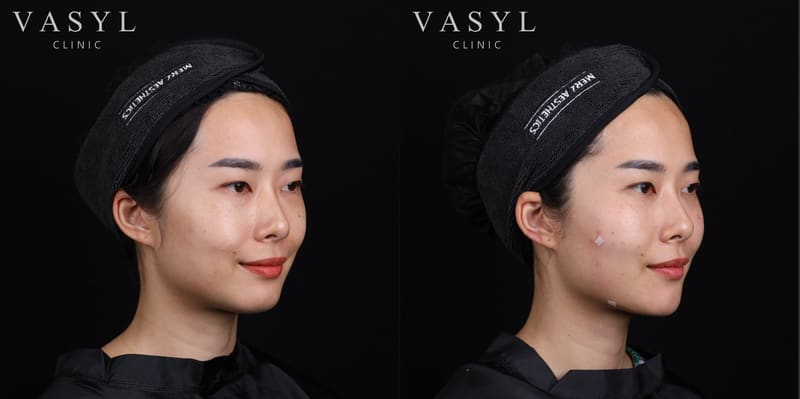 ภาพก่อนและหลังโปรแกรมฉีดกระตุ้นคอลลาเจน มุมเฉียงขวา 45 องศา