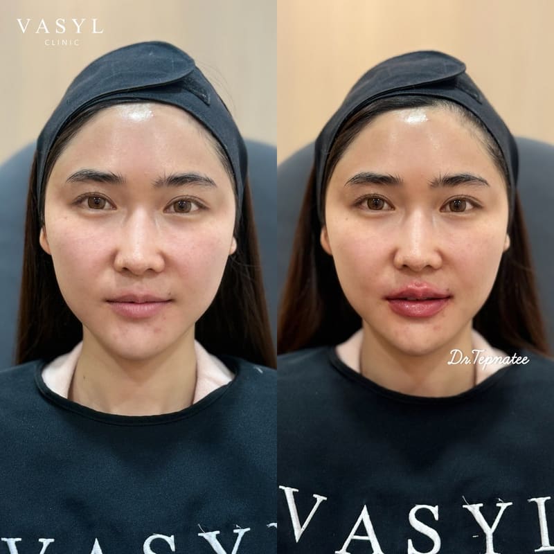 ภาพก่อนและหลังโปรแกรมฟิลเลอร์ปรับรูปปากให้ริมฝีปากดูอิ่มขึ้น (เคสที่ 1)