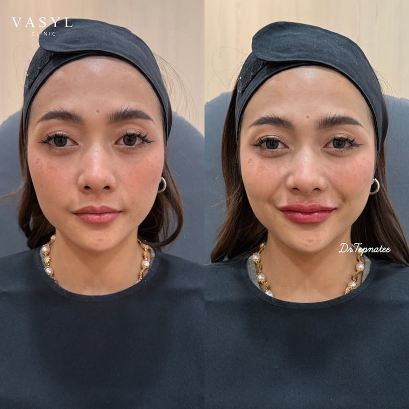 ภาพก่อนและหลังโปรแกรมฟิลเลอร์ปรับรูปปากให้ริมฝีปากดูอิ่มขึ้น (เคสที่ 3)