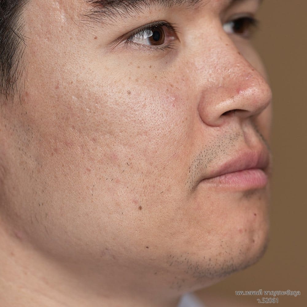 ภาพโคลสอัพผิวหน้าที่มีหลุมสิวและรอยสิวบริเวณแก้ม